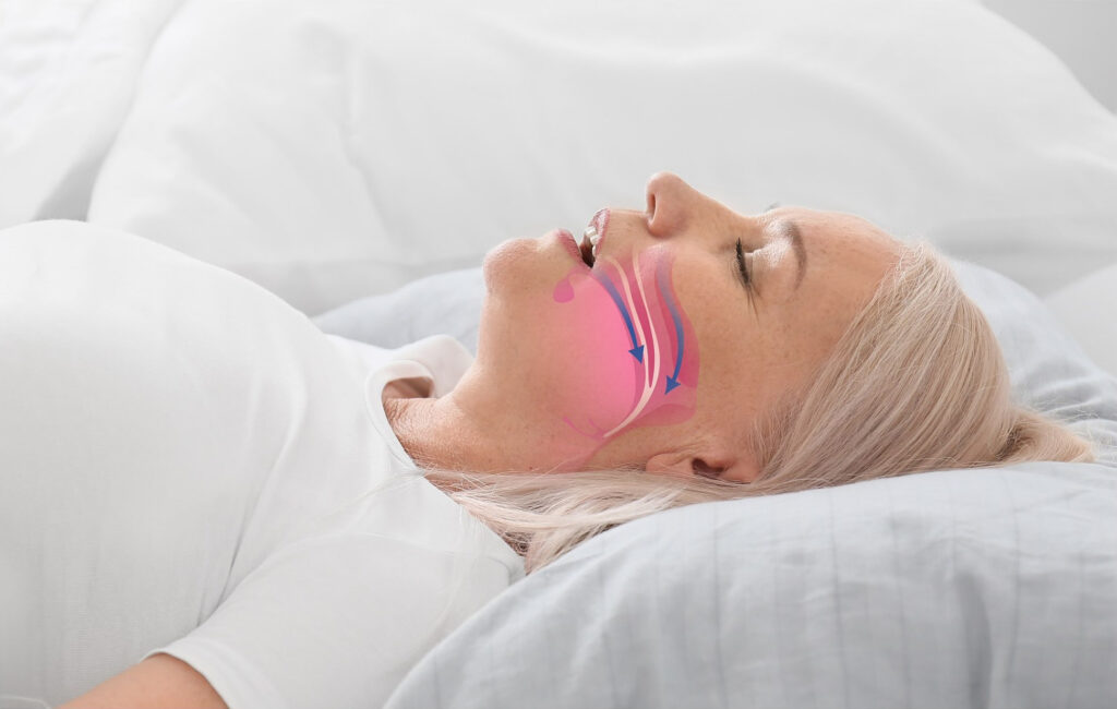 Woman laying down with illustration of obstructive sleep apnea airways, while sleeping.